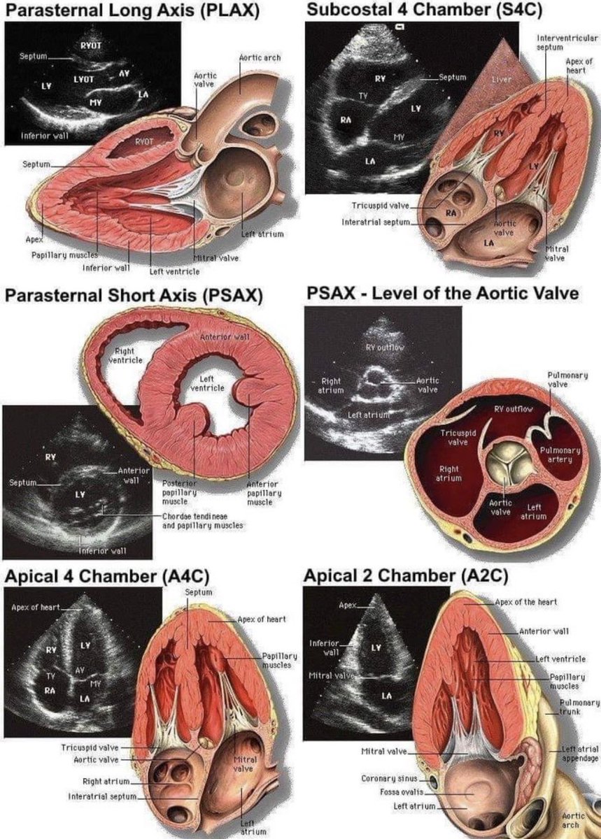 ZainKhalpey's tweet image. Core echo views: PLAX, PSAX, apical, subcostal. 

Foundation of cardiac imaging.

@MattersoftheH14 

#MedTwitter #Cardiology #Echo #POCUS