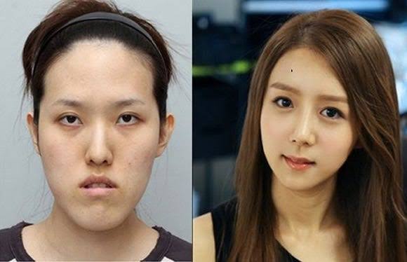 Average South Korean woman before and after a 1000 plastic surgeries.