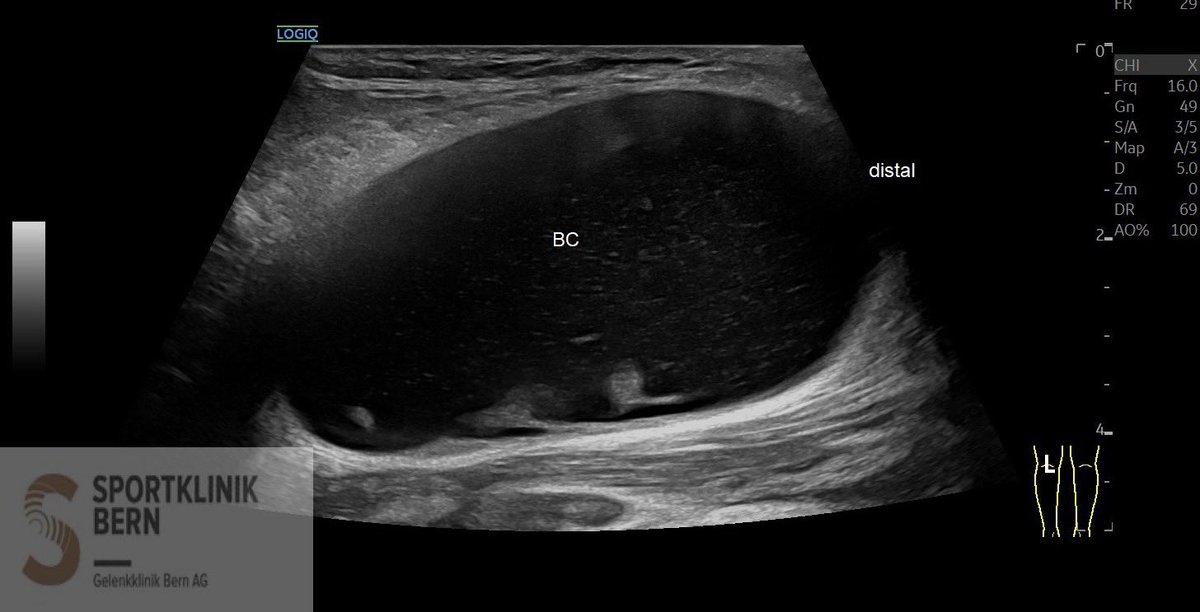 SportklinikBern's tweet photo. Bakers cyst with puncture due to severe clinical symptoms- #mskus #pocus #pocushub #GElogiqE10sr4 https://t.co/Iu3KANU4se