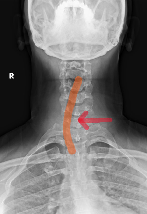 Rad_Bits's tweet photo. ANswer259: Tracheal deviation (orange) by thyroid enlargement - Always check the medline!

  #meded #radiology #foamed #usmle