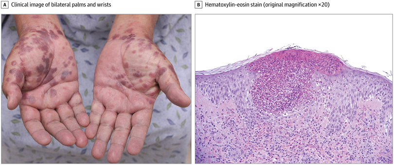 JAMADerm's tweet image. A man in his 60s undergoing #radiotherapy for prostate #cancer presented to the dermatology clinic with a 1-week history of a tender, pruritic rash to the trunk and extremities. 

What is your diagnosis? ja.ma/4cLvBB9
