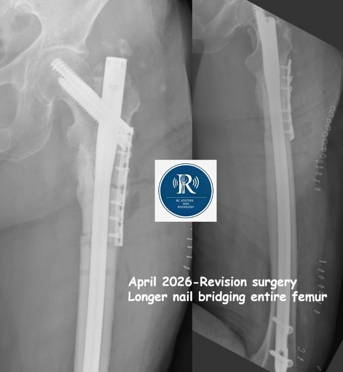 radiologybmj's tweet photo. More information on; https://t.co/l8fxmGUKiG
#AtypicalFemoralFracture #Bisphosphonate #MSKradiology #RadiologyEducation #Orthopedics #ImplantFailure #BeakingSign #MedialSpike #StressFracture #teachingcase #radiology https://t.co/PHldDMbLO2
