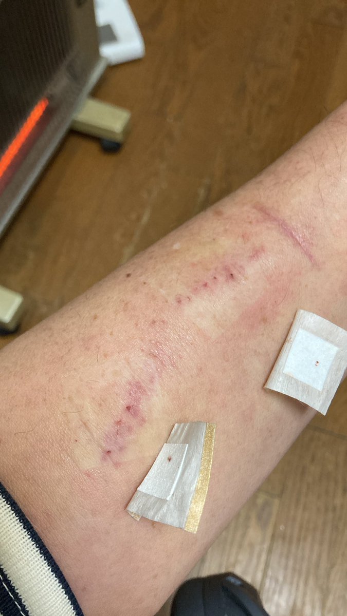kaz6thlife's tweet image. 【My #Dialysis #simptom's memo.＆ my #life】
🏥💉👩‍⚕️🩸💊🩻♿️🔪🥼🌡️

#人工透析 の問題は、#穿刺部位 の問題。劣化して使えなくなる。→#人工血管 など難問が多い。💭