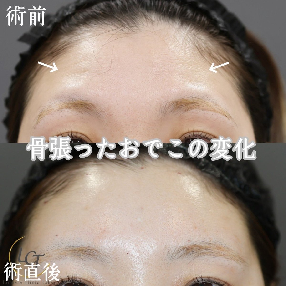 本日1件目は昨日に引き続き顔の脂肪注入

頬コケ、おでこ、こめかみ、ほうれい線が人気の注入部位となっております😌

骨ばっている方、年齢とともに脂肪が減った方など、適応かもしれません😌

カウンセリングはこちらから💁
lumiere---clinic.com