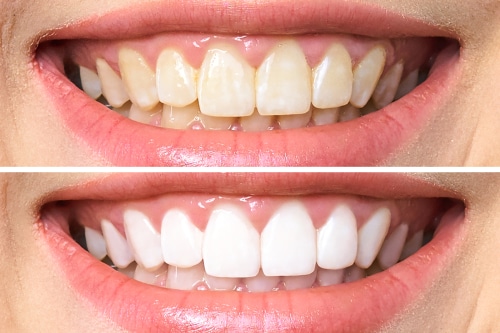 rickmillerdds's tweet image. Watch this video by Dr. Rick Miller, an experienced Dallas dentist, as he explains our at-home and in-office teeth bleaching services. #dallas #dentalimplants #dentist bit.ly/3IaBbgi