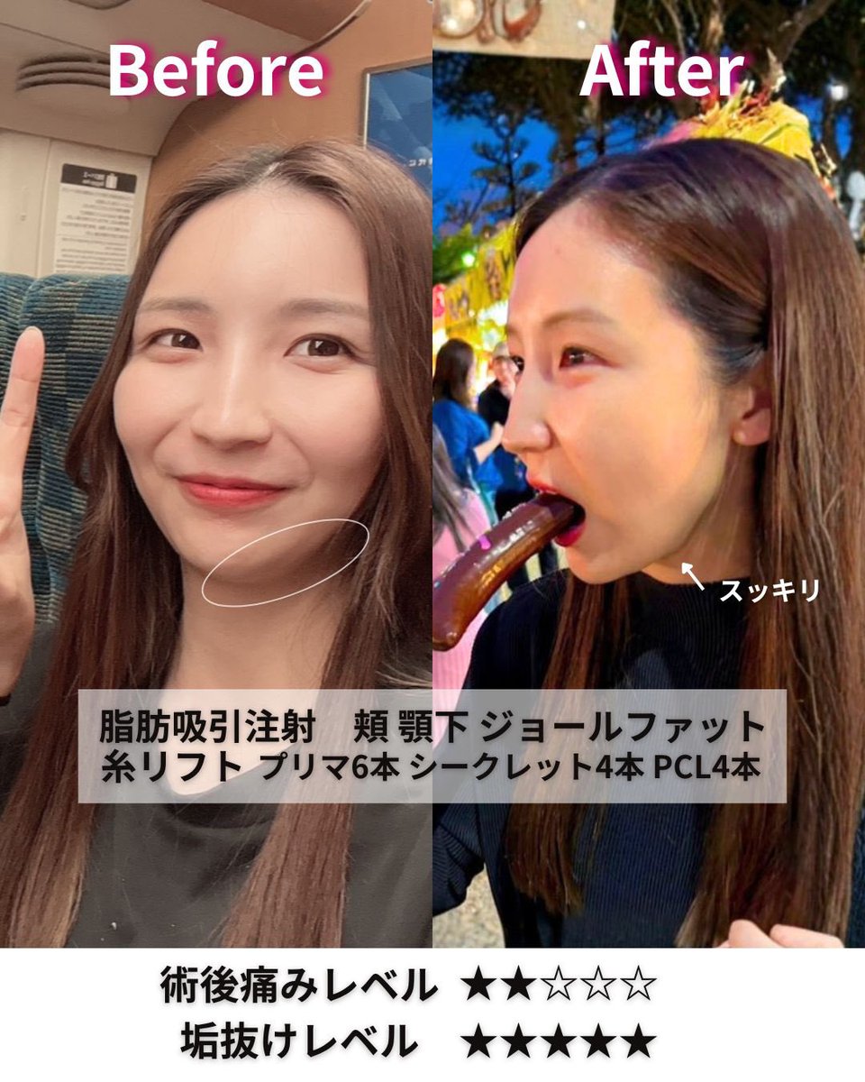 小顔輪郭整形 | 小顔KING(濱田純) / イテウォン名古屋栄院 tweet media
