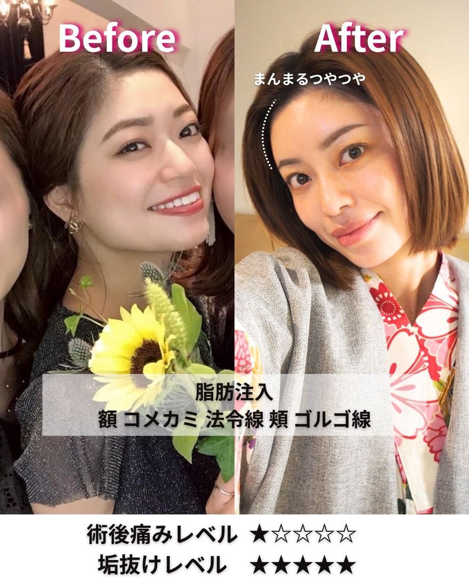 小顔輪郭整形 | 小顔KING(濱田純) / イテウォン名古屋栄院 tweet media