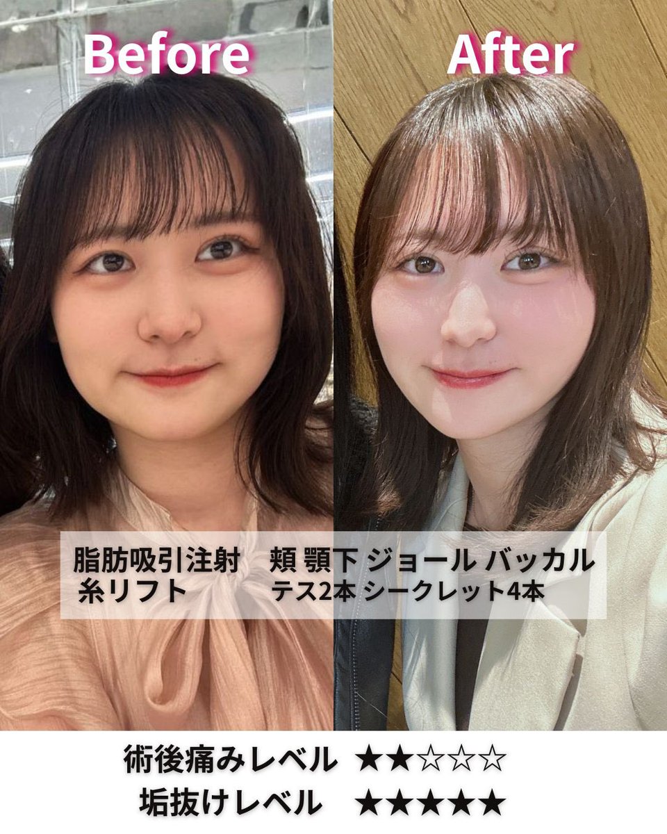 小顔輪郭整形 | 小顔KING(濱田純) / イテウォン名古屋栄院 tweet media