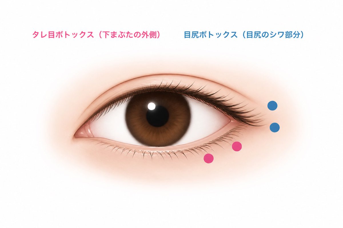 uteadealer's tweet photo. 目尻の左右差（右の方がつり目）が気になりすぎてタレ目＋目尻ボト入れてきた👀💉

効果あったら継続しようかな🙂‍↕️💭

【欲しい効果】
・目尻のつり具合の左右差改善
・目尻のしわ軽減
・笑った時の涙袋のマリモッコリ改善

#タレ目ボト #目尻ボト https://t.co/eA9fCd2YaT