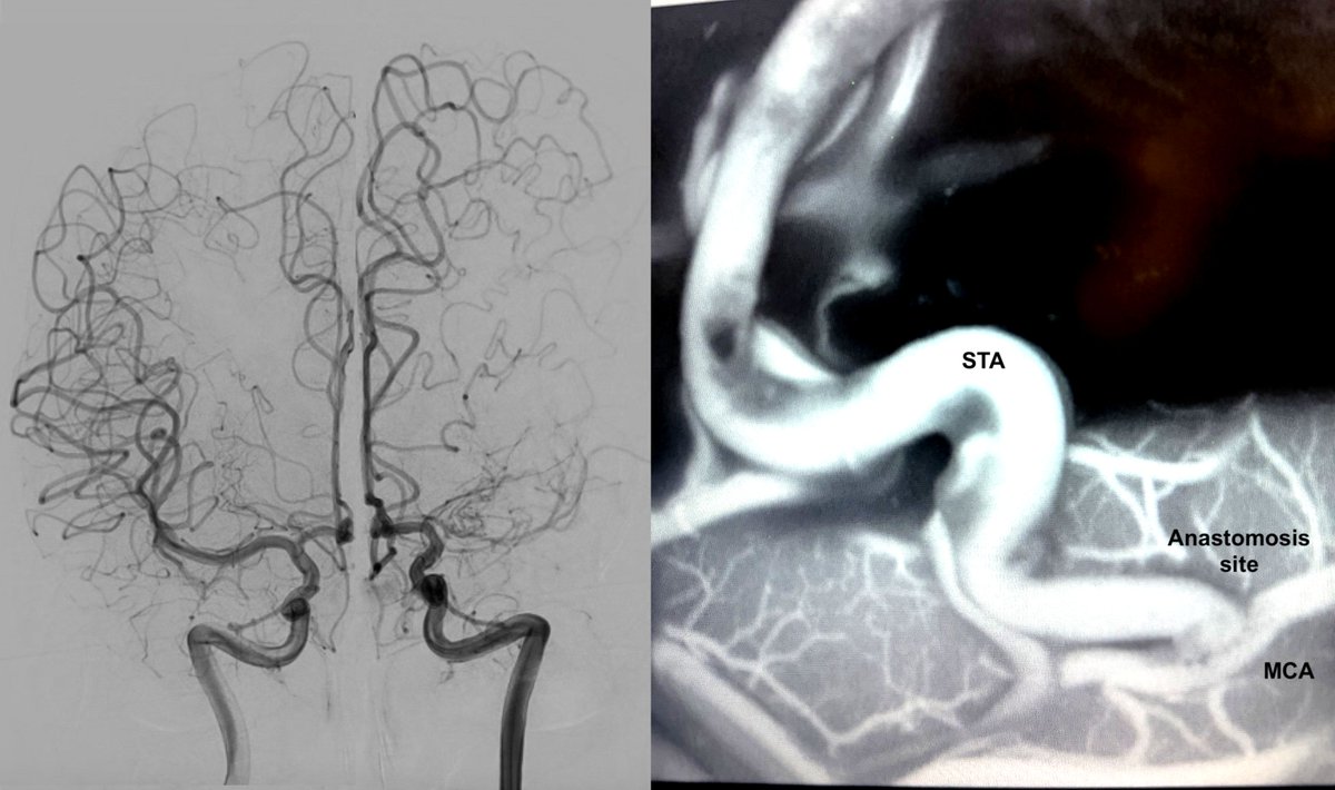 NimerAdeeb's tweet photo. Left-sided Moyamoya disease.
One of the main brain arteries (MCA) is missing on the left side → not enough blood flow → multiple strokes.
We created a new route for blood supply to the brain by connecting a scalp artery (STA) to a brain artery in a bypass surgery.
Low blood flow doesn’t just cause strokes, it can affect memory, focus, and thinking.
Restoring blood flow can change everything.

#MoyamoyaDisease #BrainHealth #BypassSurgery #StrokeAwareness #BrainSurgery #Neurosurgery #Stroke #Brain