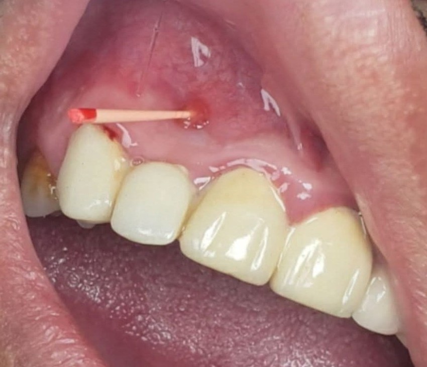 DentMaya's tweet photo. Prueba de rastreo del tracto sinusal o fistulografia.

🔹Es un procedimiento de diagnóstico preciso en odontología para determinar el origen del sinusitis o fístula, y distinguir entre enfermedad dental  y enfermedad de las encías. https://t.co/DBQ99vH2gl