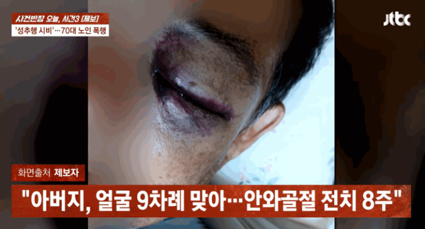 yeditor_i's tweet photo. 뇌경색으로 오른쪽 편마비가 온 70대 A씨.
운동 삼아 매일 동네 마트를 걷는 게 하루 루틴이었습니다.

지난달 24일,
맞은편에서 오는 젊은 부부를 피해 돌아가던 순간.

남성이 소리를 질렀습니다.
"야이씨, 왜 남의 와이프 엉덩이를 만져?"

A씨가 어리둥절해하며 대꾸하자
일방적인 폭행이 시작됐습니다.

9차례 연타.
몸 반쪽을 못 쓰는 70대 노인이 막을 수 있는 게 없었습니다.

주변 반응이 더 기가 막힙니다.

아내는 슬그머니 자리를 피했습니다.
바로 옆 마트 직원은 멀뚱히 보고만 있었습니다.

피투성이가 된 A씨가 직접 112에 신고했습니다.

진단 결과는 전치 8주.
과거 수술 이력이 있는 눈 부위를 집중적으로 맞아
안와골절이 났습니다.

A씨의 말입니다.
"몸 반쪽도 못 쓰는 사람이
무슨 여자 엉덩이를 만질 여력이 있겠냐."

가해 남성은 쌍방 폭행을 주장했습니다.

"먼저 맞아서 방어한 것"이라고요.

편마비 70대 노인과 젊고 건장한 남성.
이게 쌍방입니까.

성추행이 의심됐다면 경찰에 신고하면 됩니다.

확인도 안 된 의심으로 장애가 있는 노인을
아홉 번 때리는 건 어떤 이유로도 정당화될 수 없습니다.