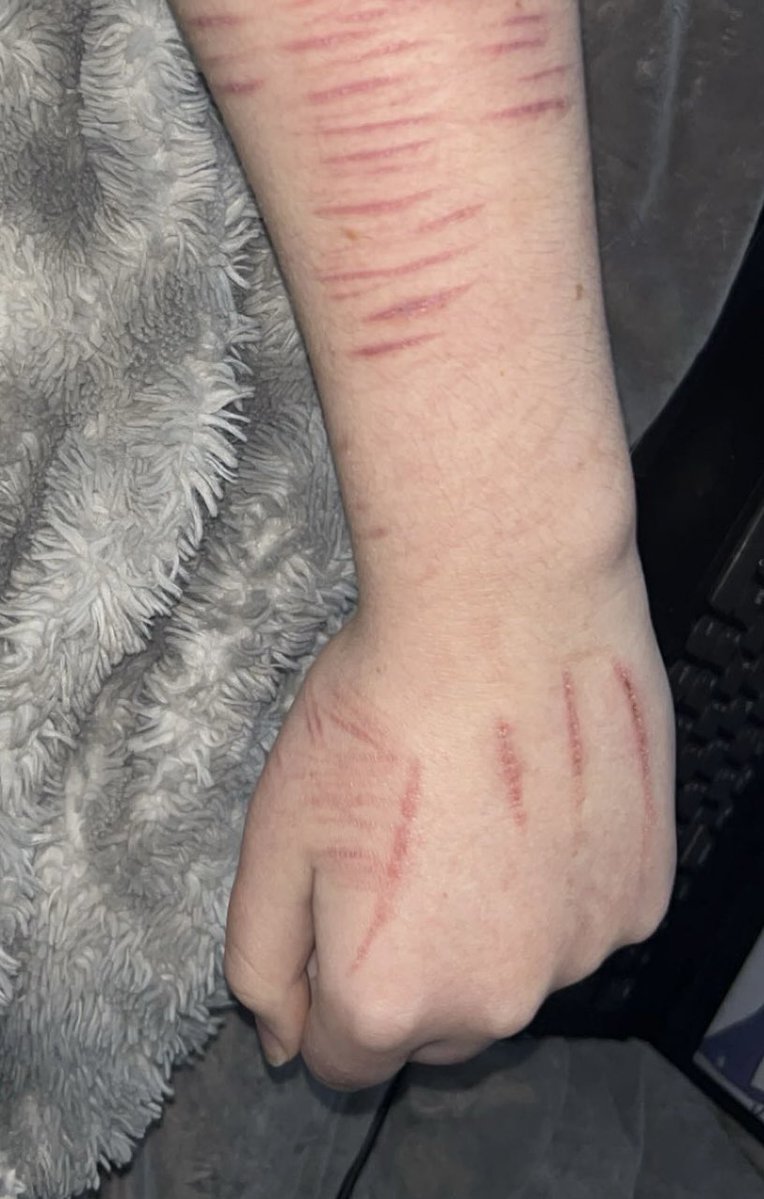 bloodsplatterss's tweet image. lowkey wanna cut my hand again (old pic) #sh #shtwt #slittwt #988twt