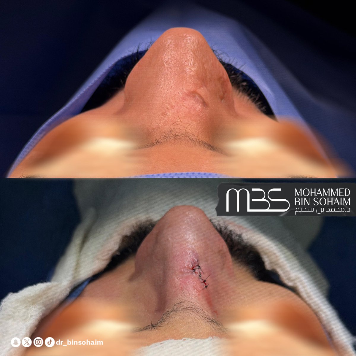 dr_binsohaim's tweet photo. عملية ترميمية مُعادَة للأنف بالطريقة المغلقة، مع الحرص على الحفاظ على تركيبة الأرنبة بشكلها الطبيعي.
الحالة لمريض تعرّض لحادث سابق، نتج عنه التئام الأنف بصورة غير منتظمة مع كسور متعددة وتليّفات بينها، إضافةً إلى وجود ندبة خارجية. https://t.co/HZivZAeCXO