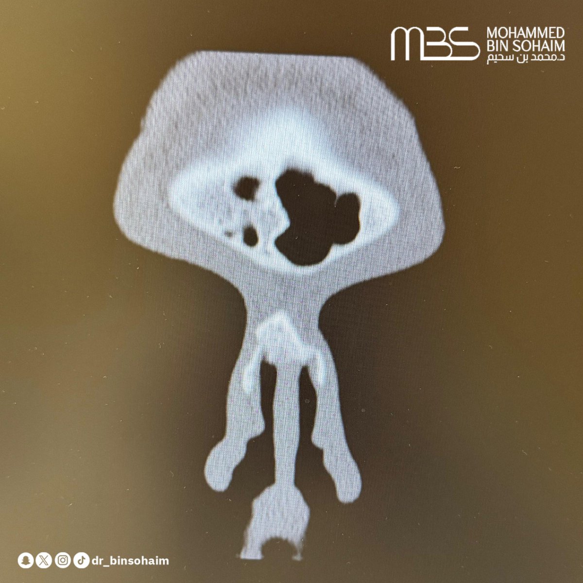 dr_binsohaim's tweet photo. عملية ترميمية مُعادَة للأنف بالطريقة المغلقة، مع الحرص على الحفاظ على تركيبة الأرنبة بشكلها الطبيعي.
الحالة لمريض تعرّض لحادث سابق، نتج عنه التئام الأنف بصورة غير منتظمة مع كسور متعددة وتليّفات بينها، إضافةً إلى وجود ندبة خارجية. https://t.co/HZivZAeCXO