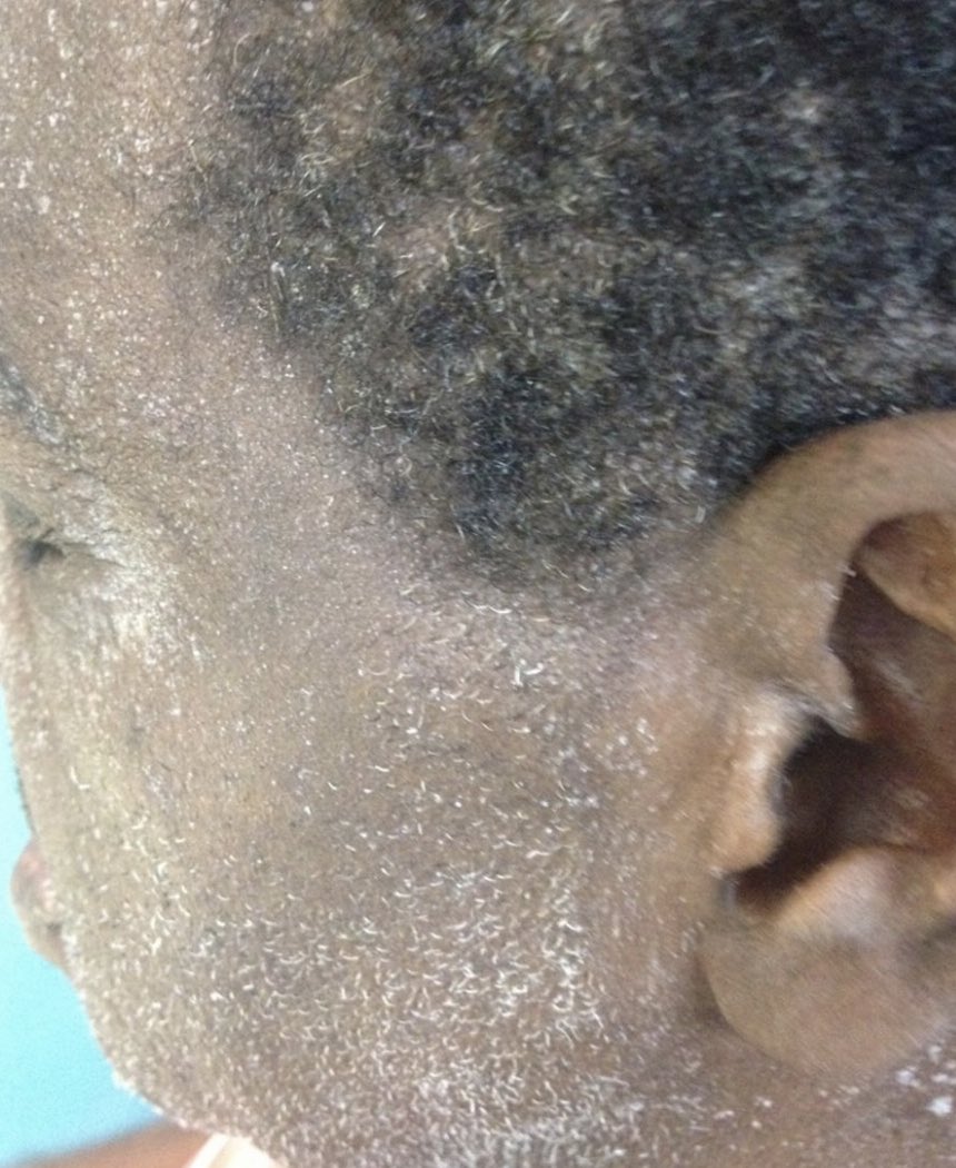 TrackYourHeart's tweet photo. A person with long-standing kidney disease develops this unusual skin appearance.
What does it indicate? https://t.co/IeiirhgbAL
