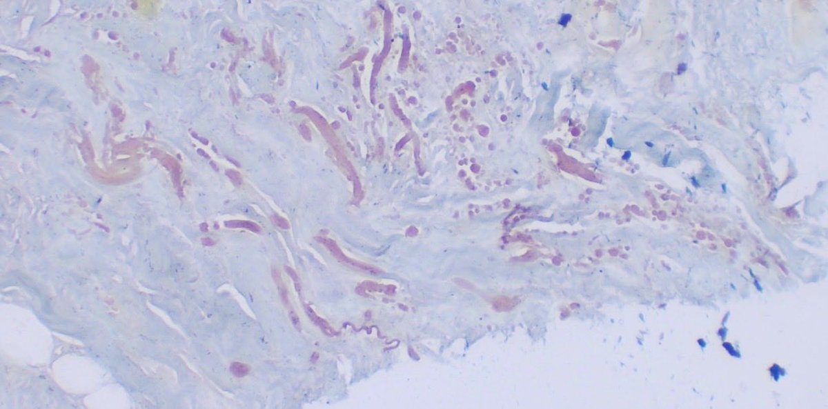 JCandidoXavier's tweet image. Pathology art of the day: abstract elastic fibers by elastofibroma

🖌️🎨🔬🔬

#path #pathology #dermpath #dermatology