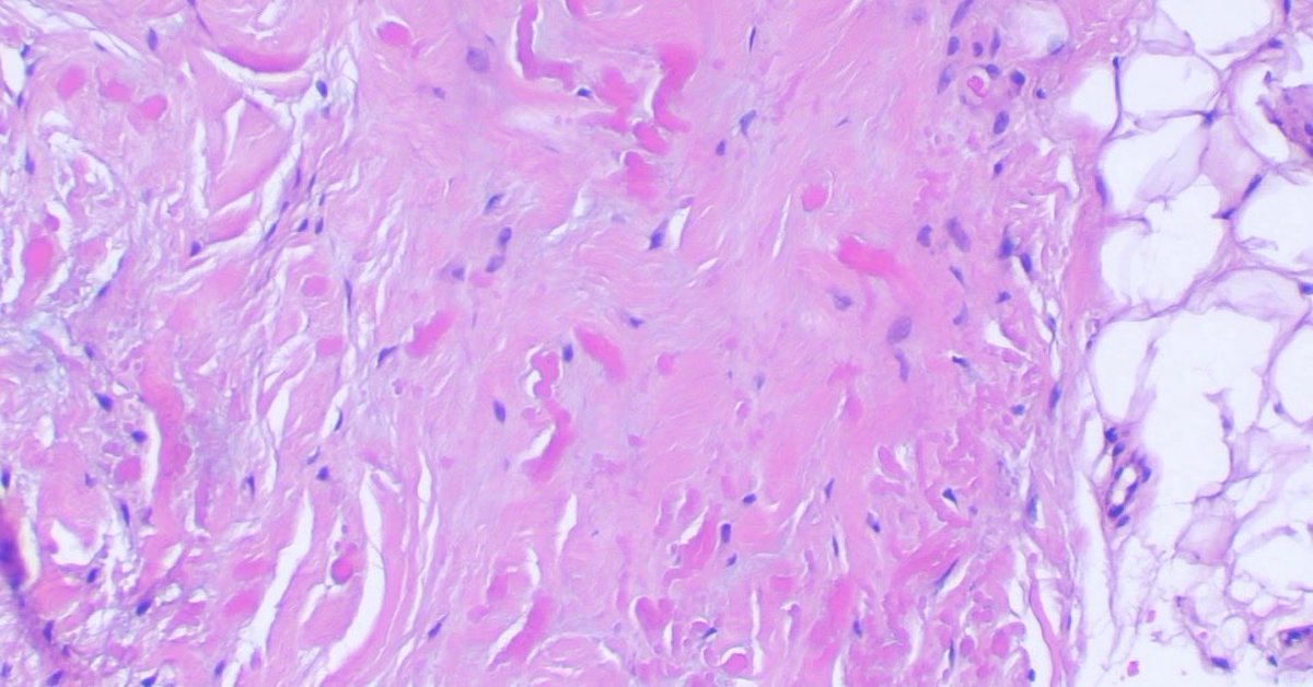 JCandidoXavier's tweet image. Pathology art of the day: abstract elastic fibers by elastofibroma

🖌️🎨🔬🔬

#path #pathology #dermpath #dermatology