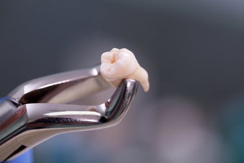 guldandds's tweet image. Do you need a tooth extracted? Experience comfortable and pain-free tooth extractions by Dr. Michael T. Guldan to relieve your oral pain. 
#winthrop #dentalimplants #dentist bit.ly/4bbXOhK