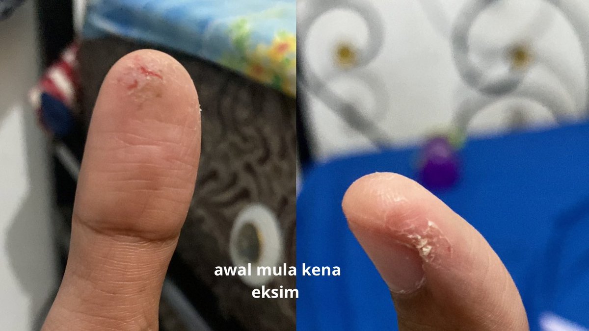 fadhilahahaha's tweet photo. Aku ngerasa terbantu bgt pake body oil ini. Jadi, kulitku ini emng kering ditambah ada bagian kulit yg kena eksim di jempol tangan dan itu kalo lg kambuh jd kering bgt kulitnya sampe mengelupas+pecah :(
 (btw aku pertama kena eksim pas tahun 2025) 

#dhilreview https://t.co/YzHcl56KKN