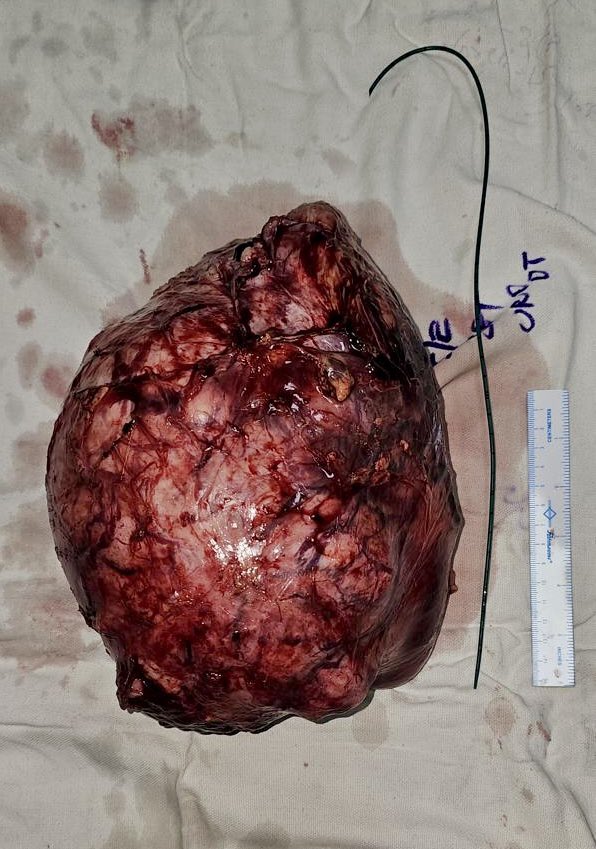 SudheerDevana's tweet image. Some renal masses are meant for open surgical excision only. 30 yr old female with a huge left renal mass underwent radical nephrectomy. Lot of Need for patient awareness in India   #renalcancer #kidneycancer #cancersurgery #cancerawareness