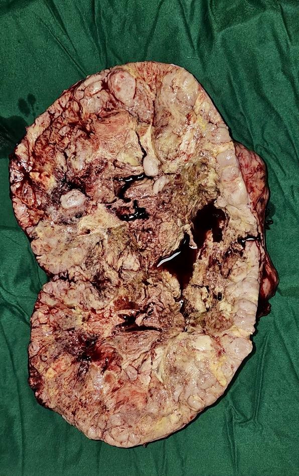 SudheerDevana's tweet image. Some renal masses are meant for open surgical excision only. 30 yr old female with a huge left renal mass underwent radical nephrectomy. Lot of Need for patient awareness in India   #renalcancer #kidneycancer #cancersurgery #cancerawareness