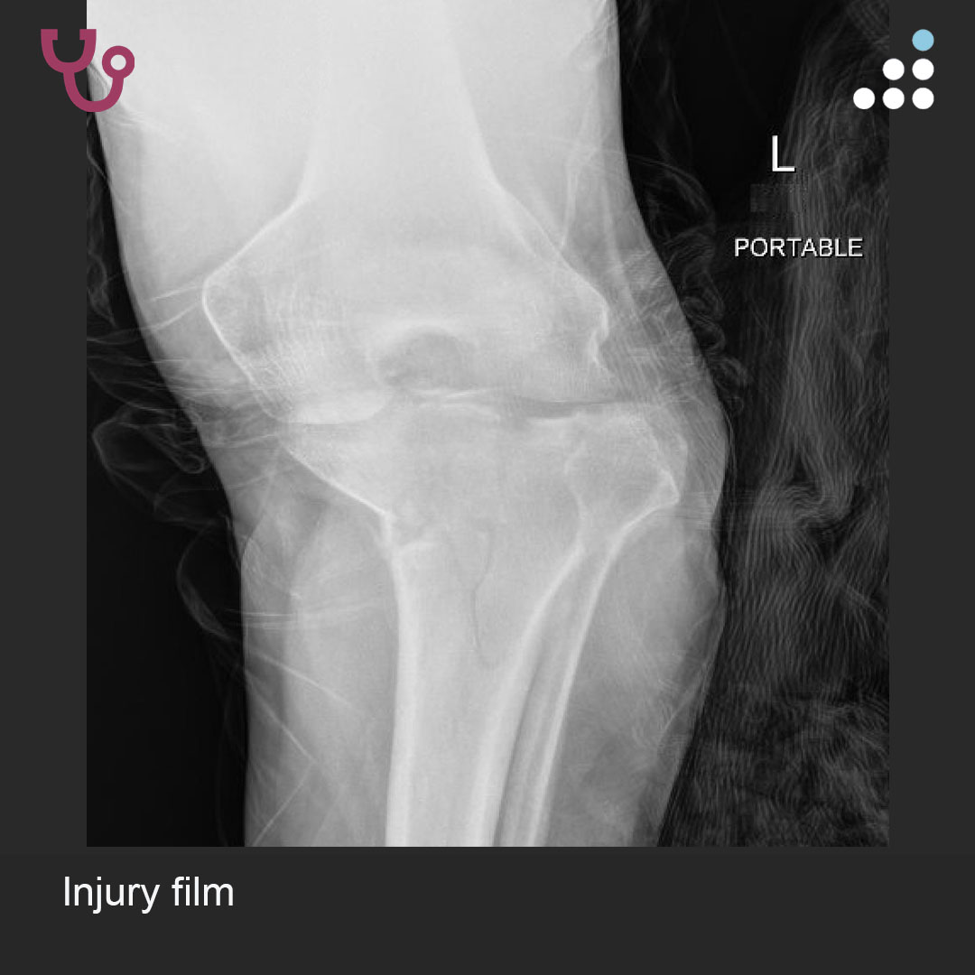 orthobullets's tweet image. Here is a new case by Dr. Niloofar Dehghan and The @CORE_Institute.

TIBIAL PLATEAU FX WITH MENISCAL TEAR AND CONCERN FOR ACS IN 45F

How would you manage this #orthotwitter?

Vote on this case for CME: orthobullets.tiny.us/466pp34b