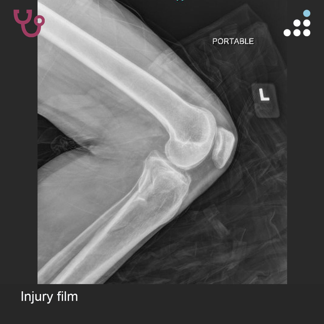 orthobullets's tweet image. Here is a new case by Dr. Niloofar Dehghan and The @CORE_Institute.

TIBIAL PLATEAU FX WITH MENISCAL TEAR AND CONCERN FOR ACS IN 45F

How would you manage this #orthotwitter?

Vote on this case for CME: orthobullets.tiny.us/466pp34b