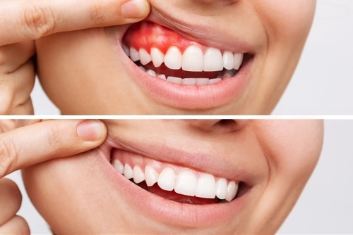 RivieraDC's tweet image. In this video, Dr. Chance McLemore explains the potential causes of bleeding gums and the importance of scheduling a hygiene visit. bit.ly/3HbqQ6r #foley #alabama #dentalimplants #dentist