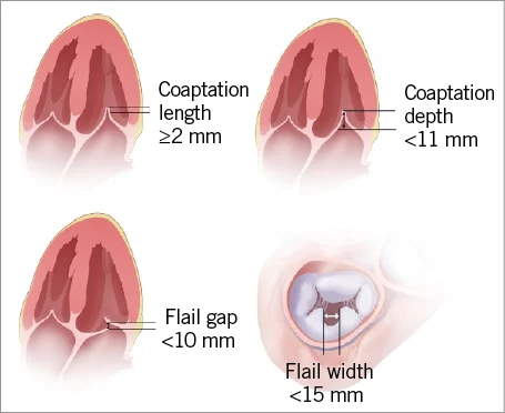 RitikaTuliMD's tweet photo. 🫀 #CardioNugget: 

Coaptation Length vs Coaptation Depth

📍 Coaptation Length
➡️ Length of leaflet overlap during systole
➡️ Think: “How much do the leaflets seal?”
🔴 Short length = poor closure → ↑ MR
✅ Favorable for MitraClip: ≥2 mm

📍 Coaptation Depth (aka tenting depth)

➡️ Distance from annular plane → coaptation point
➡️ Think: “How far are the leaflets pulled down?”
🔴 Increased depth = leaflet tethering → functional MR
⚠️ >10 mm → worse repair outcomes

#CardioNugget #MedEd #CardioMed #MitraClip