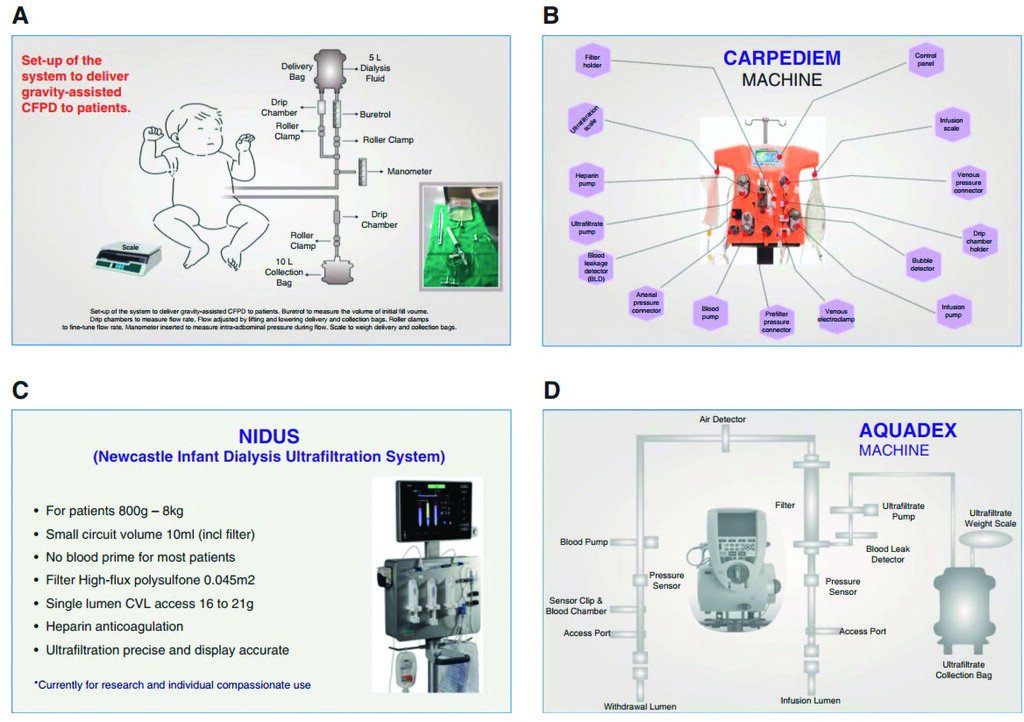 kdjhaveri's tweet photo. ASN Kidney News May 2026 Biofilter-Based Continuous Kidney Replacement Therapy in Pediatric Acute Kidney Injury: Tailoring Technology for Small Patients --Pranav Sivaram @rupeshrainamd 

https://t.co/Cef6SXOia4 @asnpublications https://t.co/KzXDBPPgFg