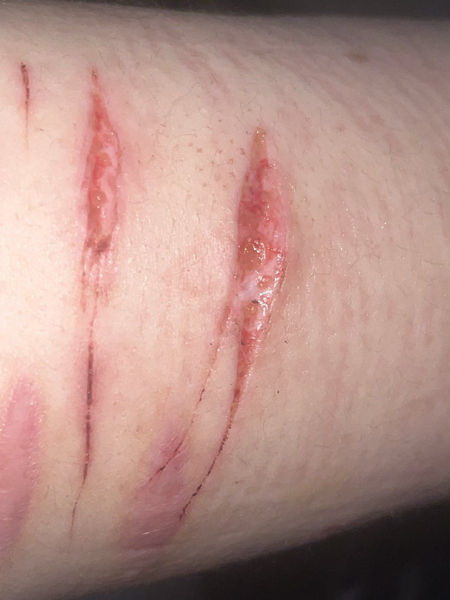 manestella_'s tweet photo. Gross healing process ew ew ew ew ew ew ew ew ew ew ew ew yuck yukc yucky yucky yuck yuck ew gross gross ew yuck #shtwt #shedtwt #slittwt https://t.co/dVyfMSiD2z