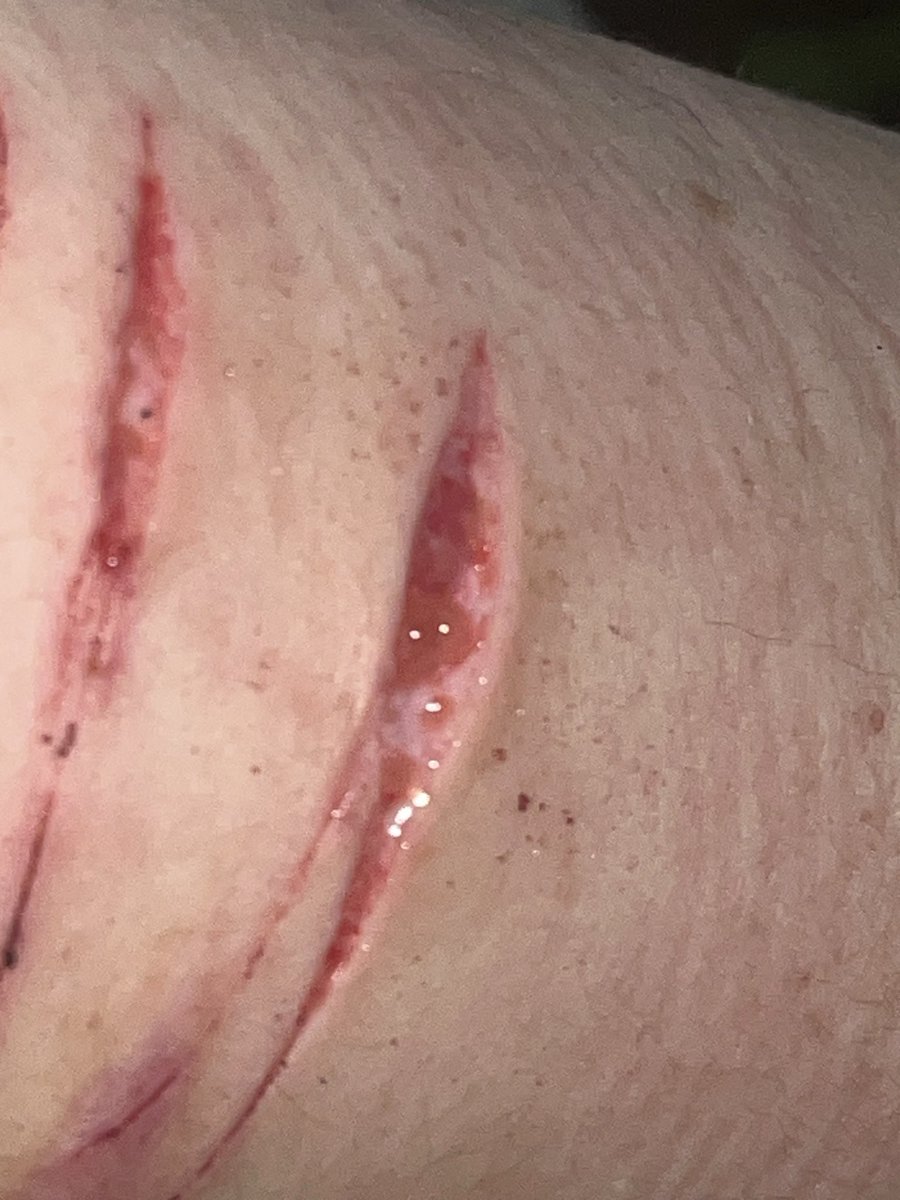 manestella_'s tweet photo. Gross healing process ew ew ew ew ew ew ew ew ew ew ew ew yuck yukc yucky yucky yuck yuck ew gross gross ew yuck #shtwt #shedtwt #slittwt https://t.co/dVyfMSiD2z