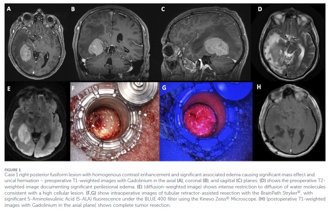 King's Neurosurgery tweet media