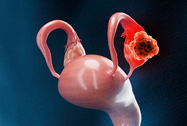 SpecialtyPharm's tweet photo. New FDA approval in ovarian cancer
relacorilant + nab-paclitaxel shows improved PFS &amp; OS in platinum-resistant disease: https://t.co/6DJGT1PzQ4
#Oncology #FDA https://t.co/oLlY9ZPNT3