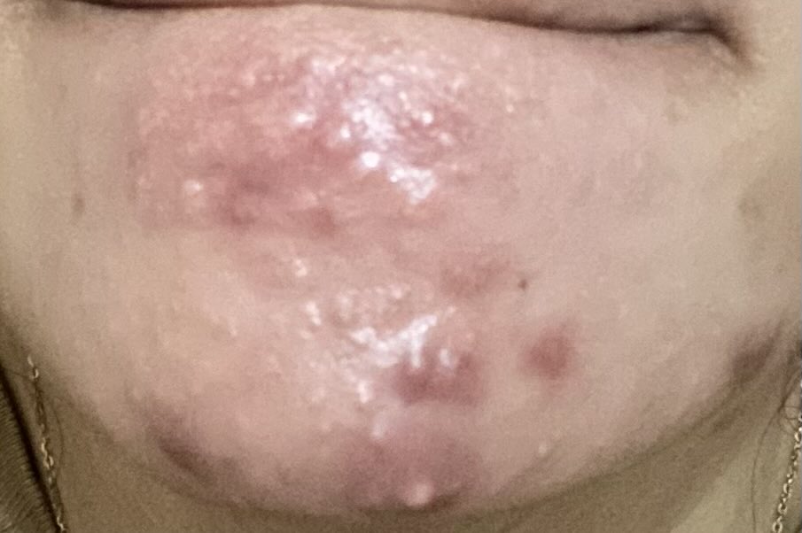 cuttiesspiee's tweet photo. happy bgt sekarang kalo ada jerawat mendem uda cepet bgt keluarnyaaa ga perlu nunggu seminggu lebih baru kempes😭btw ini foto baru 2 hari uda keluar putih putihnyaaa semoga besoo dah langsung meletus ya👀🫵🏻 https://t.co/aeaEM7V3M7