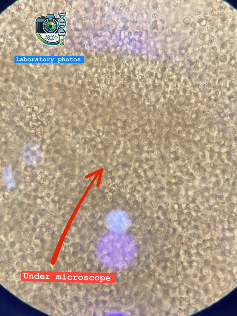 lab_phot's tweet photo. سوف اقسم المحتوى الى نصفين 

🟡الاول :شرح الحالة هذه الذي ترونها 

🟡الثاني :اسباب ظهور البول باللون الحليبي https://t.co/NTYBd5529U