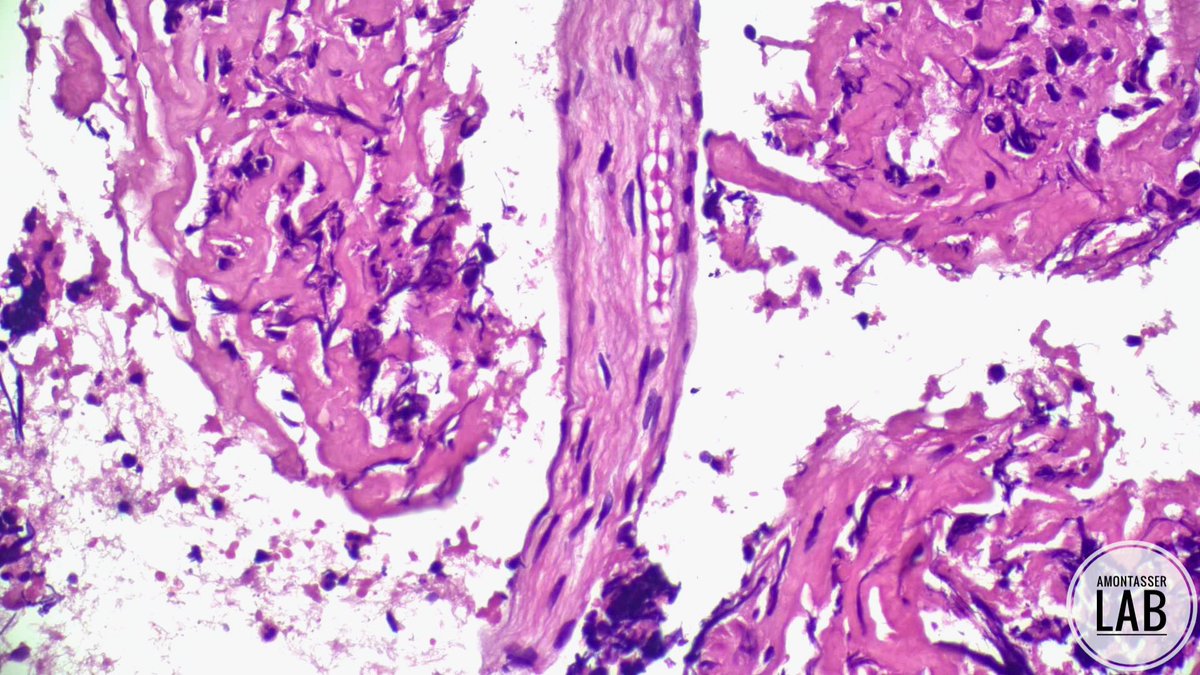 AMontasserMD's tweet photo. Schmidt-Lanterman incisure in a peripheral nerve 💗
#Pathology #PathArt #Histology