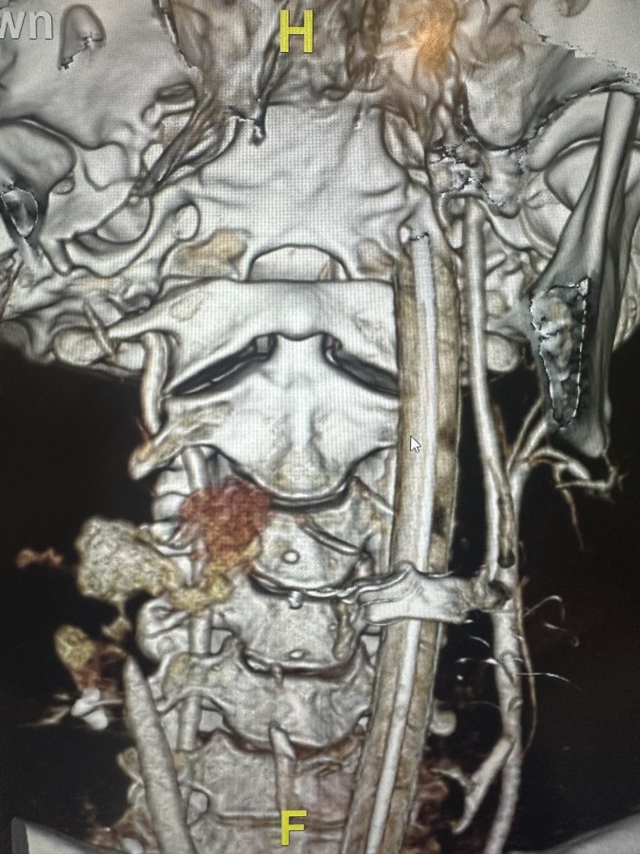 BehindTheKnife's tweet photo. GSW to the neck.  Do you know what to do?

It starts with a good foundation. Be prepared. Our Trauma Surgery Video Atlas is the only resource available that demonstrates a clear, step-by-step to the gnarliest injuries.

See BTK video in 🧵below ⬇️

🔗 https://t.co/gPhJG6czV1 https://t.co/UADxVyk75i