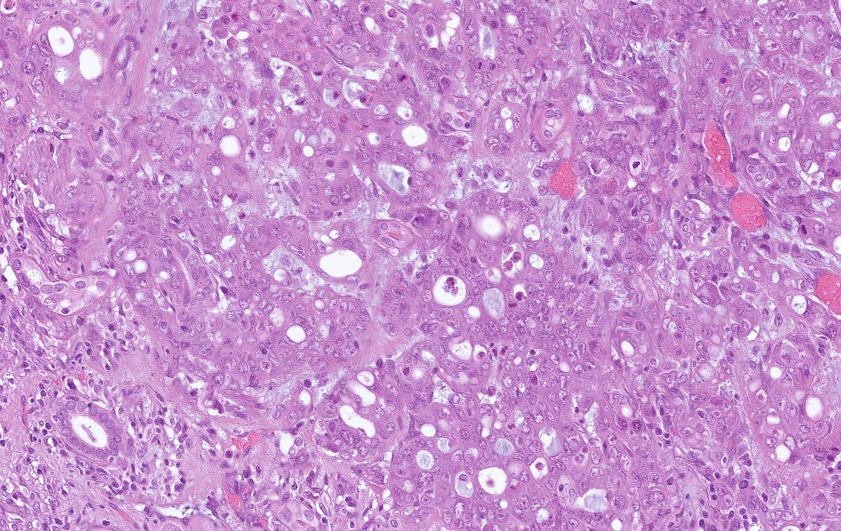 DrCycloPath's tweet photo. #PathQuiz 🔬🧬 #Kidney #Pathology #GUPath

A) Collecting Duct Carcinoma
B) Invasive Urothelial Carcinoma
C) ALK-Rearranged Renal Cell Carcinoma
D) SMARCB1-deficient Renal Medullary Carcinoma https://t.co/uoaj0keboL