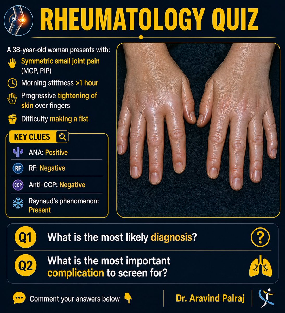Rheumat_Aravind's tweet image. 38F with symmetric MCP/PIP pain

morning stiffness
skin tightening
Raynaud’s

Q1: Diagnosis?
Q2: Key complication to screen?

👇

— Dr. Aravind Palraj

#Rheumatology #MedEd #ClinicalReasoning #RheumTwitter
