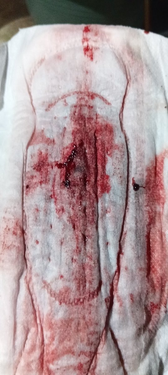 CrewLincak58457's tweet image. Ini mens yg sore punya nya tetangga darahnya masih segar, gumpalan darahnya enak

#mens #cewekmens #pms #pembalut