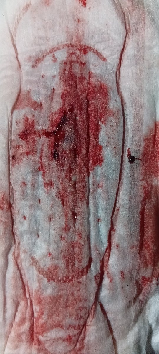 CrewLincak58457's tweet image. Ini mens yg sore punya nya tetangga darahnya masih segar, gumpalan darahnya enak

#mens #cewekmens #pms #pembalut