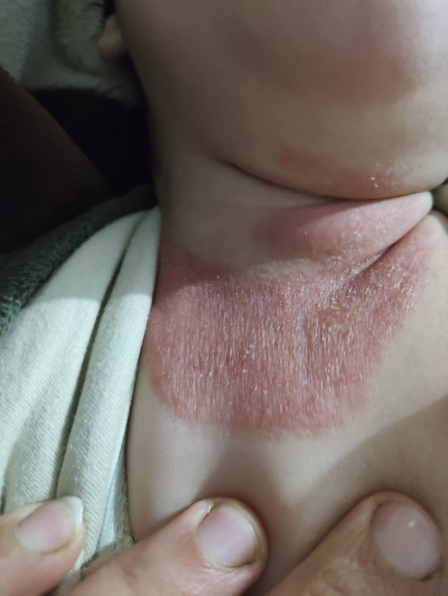 hmd_mhmd9832's tweet image. My heart hurts today 💔  
My little girl’s neck looks like this, and the redness keeps getting worse right in front of my eyes 😔  
Every time I see her like this, I feel so helpless and scared for her.