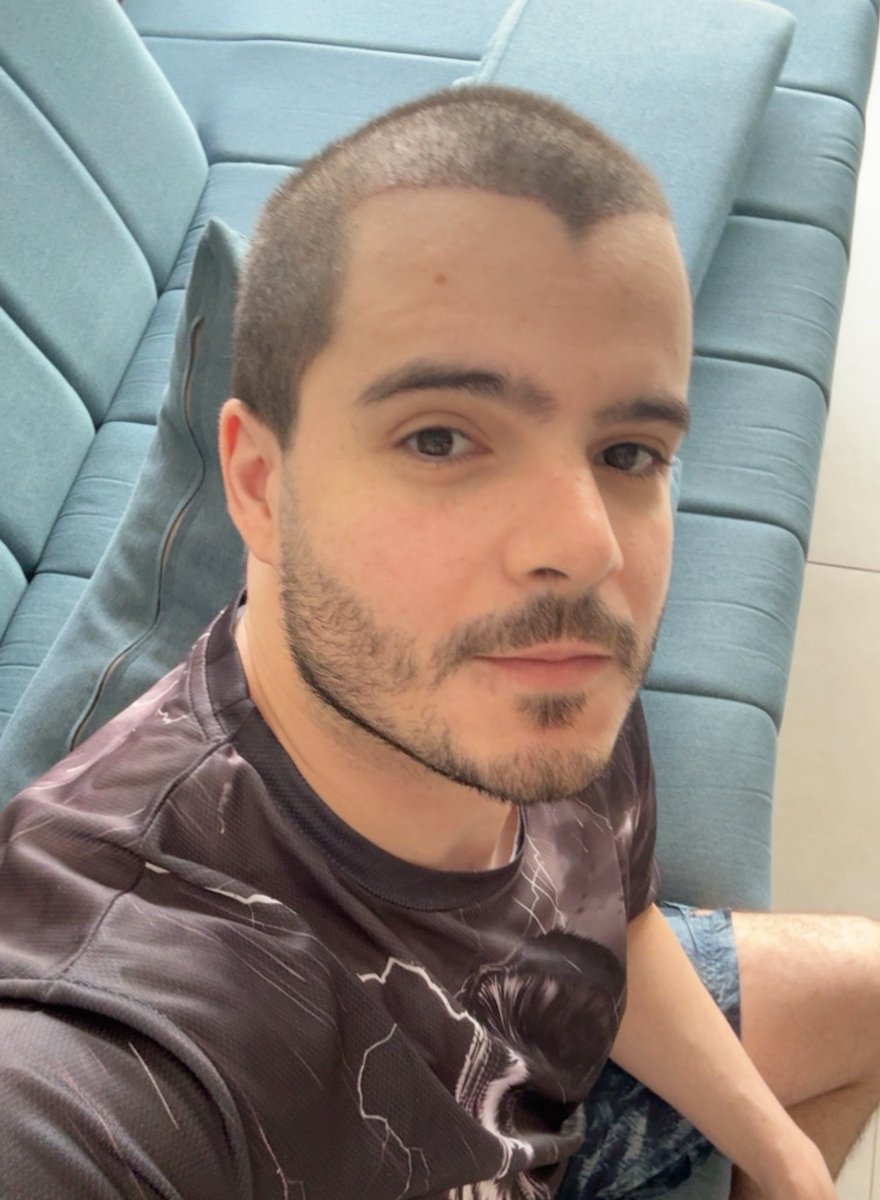 edipoarthurm's tweet photo. Relação de amor e ódio com a skin carequinha do transplante. https://t.co/kf10oVVZ0S