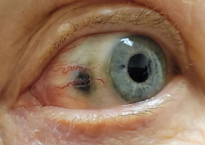 PeterItebimien's tweet image. Patient presented to the clinic with complaints of joint pain and urine that darkens after peeing. The eye 👇.What is the likely diagnosis ? Complications?
Management? 
#MedTwitter #MedX #MedEd #GITwitter #CardioTwitter 
@IhabFathiSulima @elidyynwa @docakx