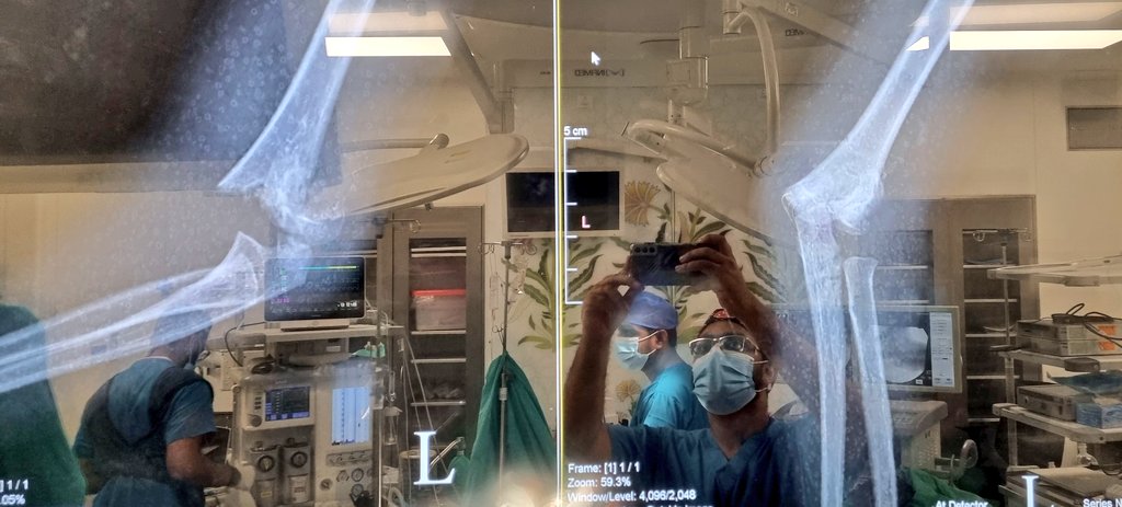 joyboy3160's tweet photo. Supracondyler fracture 
Close reduction percutaneous pinning done...
Wasn't easy to reduce in close... https://t.co/zXRDhxqcv3