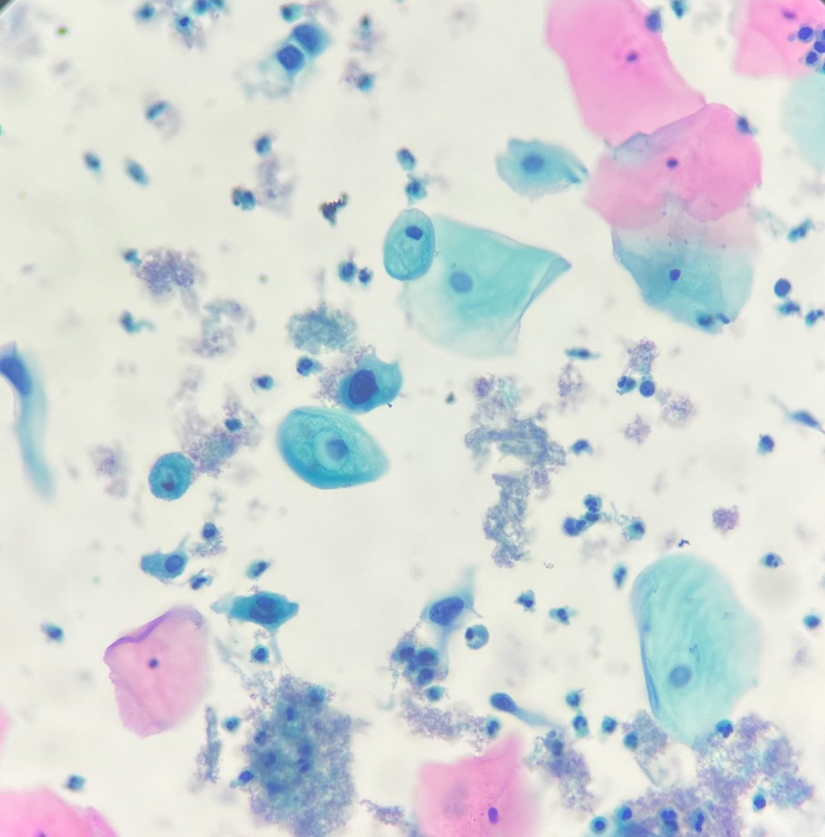 senaadsizdayanc's tweet photo. LSIL, smear (23Y, hpv other positive patient)
#surepath
#cytopathology
#gynpath
#pathology https://t.co/e2RN1IqBnP