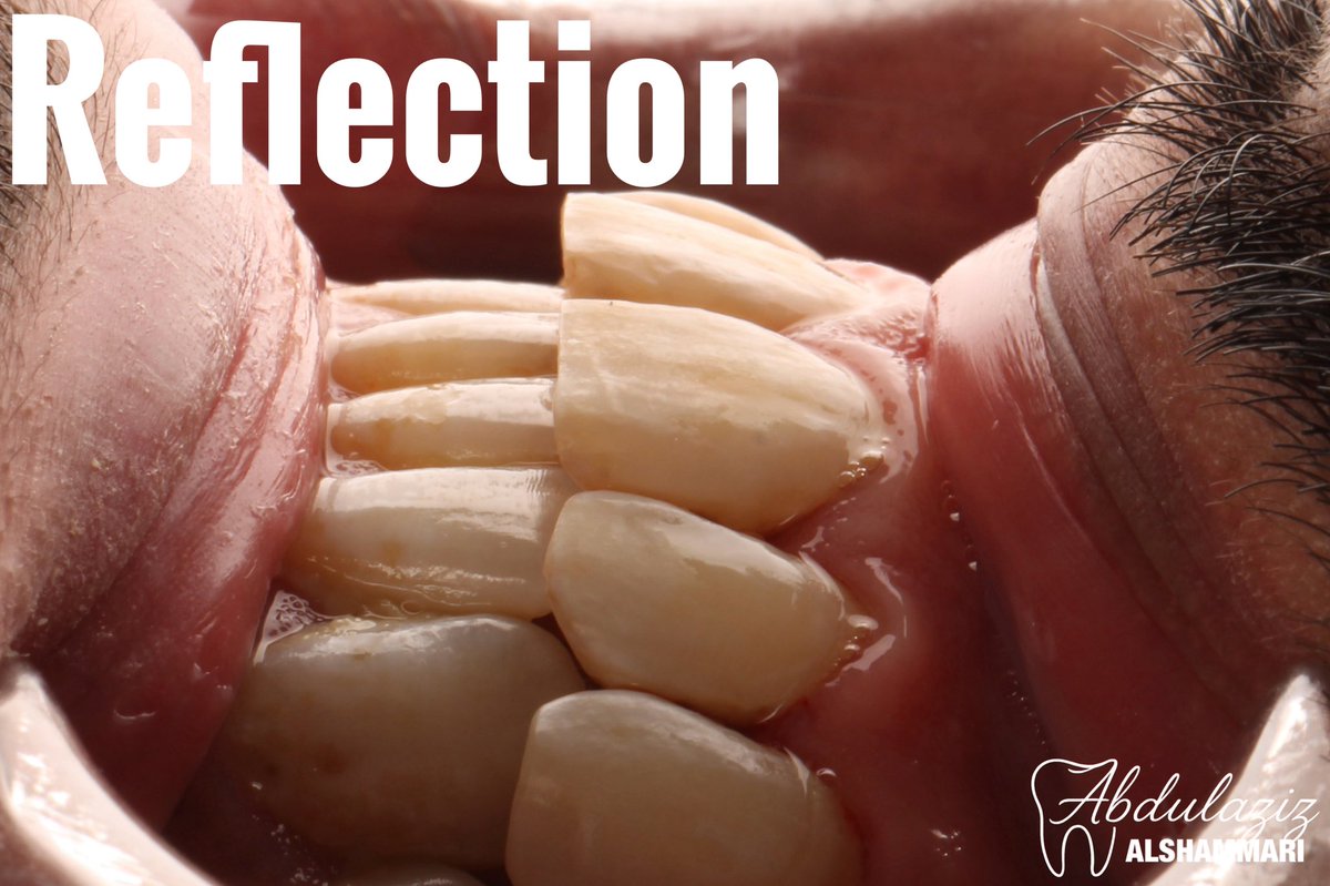 dent_aziz's tweet image. نتيجة الكشط المجهري وتقنية ICON على سطح الأسنان

The result of micro-abrasion and ICON treatment on the tooth surface

#dentistry #dentist #conservative #hail #طب