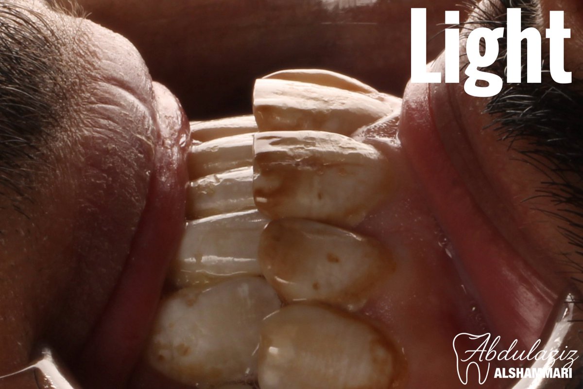 dent_aziz's tweet image. نتيجة الكشط المجهري وتقنية ICON على سطح الأسنان

The result of micro-abrasion and ICON treatment on the tooth surface

#dentistry #dentist #conservative #hail #طب